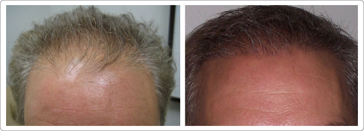 hair transplantations nyc, hair transplants nyc, neograft nyc