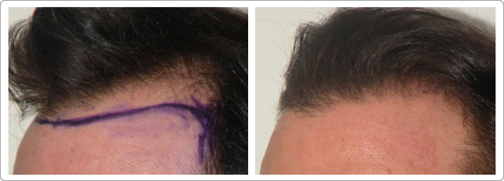 hair restoration nyc, neograft nyc, hair transplantation nyc