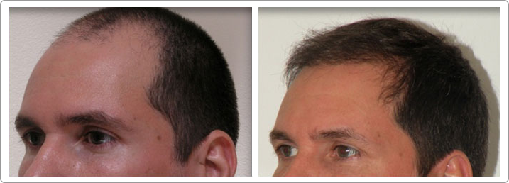 hair restoration nyc, hair transplantation nyc