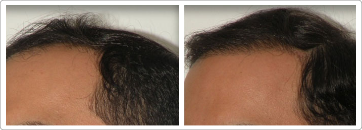 neograft nyc, hair restoration nyc, hair transplantation nyc