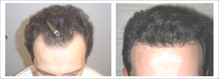 hair restoration nyc, hair transplantations nyc, neograft nyc