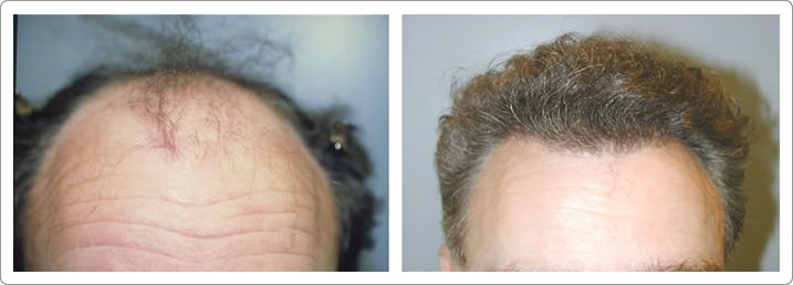 hair restoration nyc